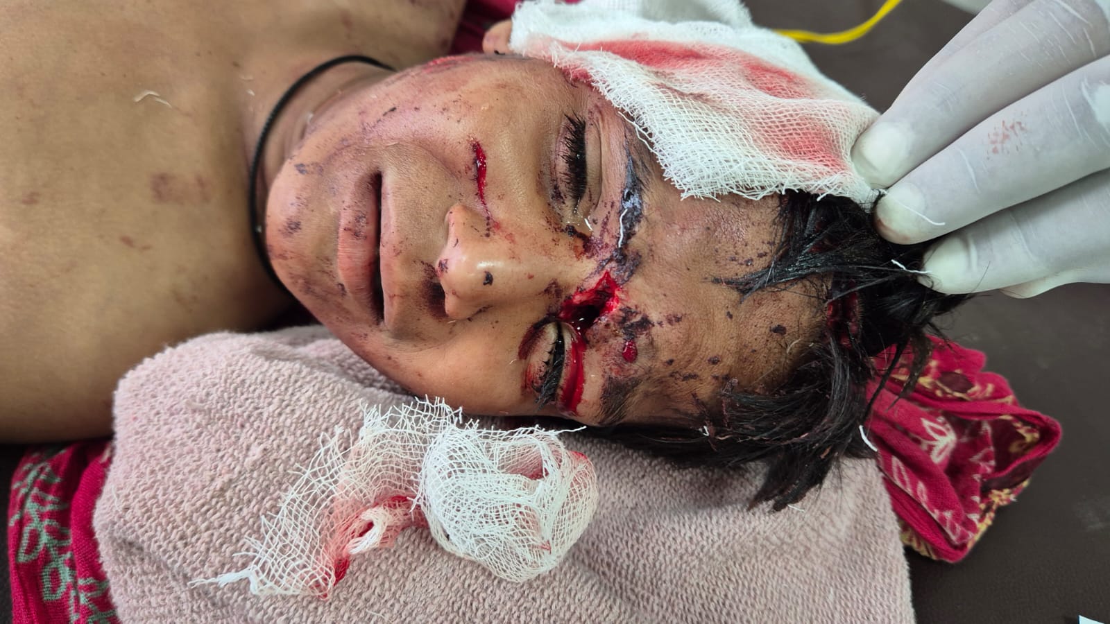 Dog Attacked आवारा कुत्तों का हमला: स्कूल से लौट रहे बच्चे को नोचा